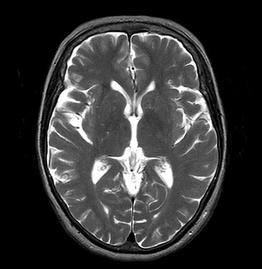 MRI Brain Scan (AI Enhanced)